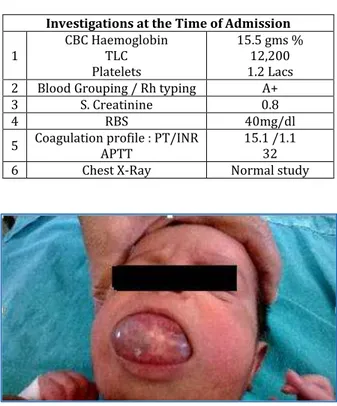Fig. 1: Oral Lymphangioma at the time of presentation 