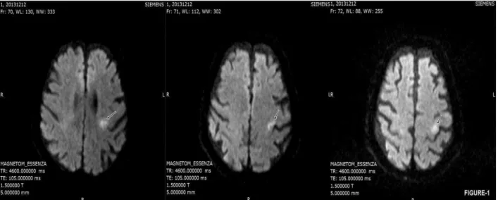 Figure 1. Diffusion weighted imaging (DWI) revealed an acute ischemic infarct in the left precentral gyrus