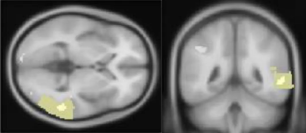 Figure 5. Axial and coronal views of the activation of the right medial temporal gyrus during the  recognition of pantomimes contrasted with meaningless gestures (p < .0001, uncorrected).