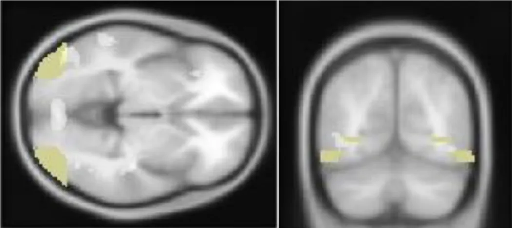 Figure 7. Axial and coronal views of the activation of the bilateral middle occipital gyrus during the  recognition of meaningless gestures contrasted with meaningful gestures (p < .0001, uncorrected) Table 5  
