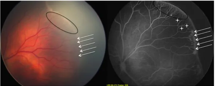 Figura  1  -  (caso  nº  1-  OE)-  A  imagem  de  AF  evidencia  a  presença  de  lesões  hiperfluorescentes  tipo popcorns (setas  brancas), não  identificáveis  na  imagem  de  retinografia