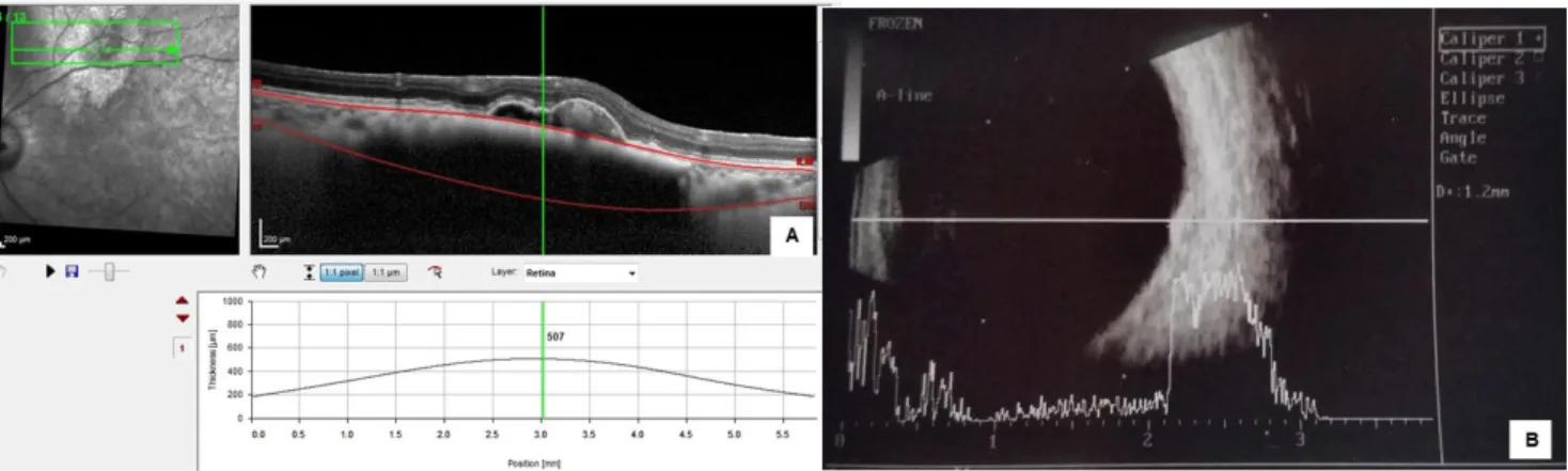 Figure  1  -  Choroidal  nevus  thickness  measured  by  EDI-OCT  and  ultrasound.  (A)  With  EDI-OCT  the  internal  and  external  boundaries  are  identified  (retinal  and  scleral  thickness is not included in the measurement)