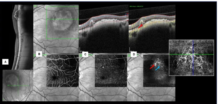 Figure  5  - Multimodal  imaging  of  a  patient  with  a  left  macular  nevus,  PCV  and  SRF