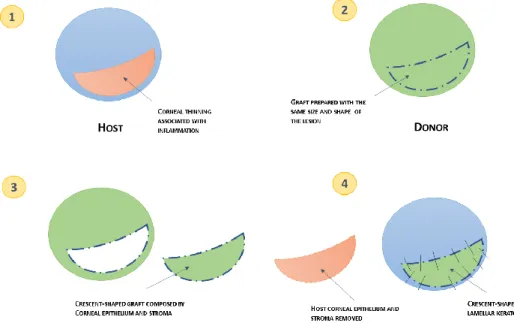 Figure 1 - Schematic representation of crescent-shaped deep anterior lamellar keratoplasty