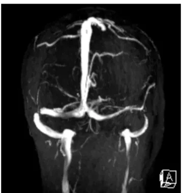 Figura 5 - Resolução do papiledema 