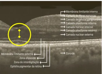 Figure  1  -  Identificação  das  camadas  da  retina  e  coróide  na  região  macular  e  demonstração da medição manual da camada nuclear externa (amarelo) 
