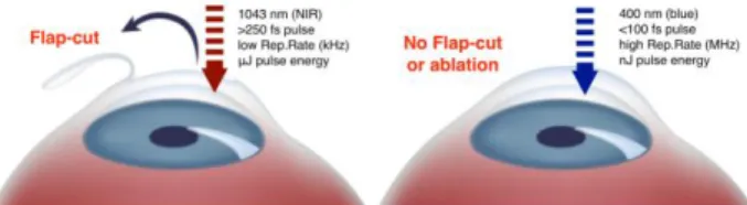 Figure  2,  shows  schematically  the  main  differences  between the two laser procedures: FLEX (which is a more  advanced LASIK variation that uses a single femtosecond  laser to create the corneal flap and the refractive lenticule  in one step) and the 