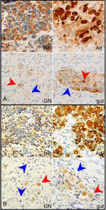 Table 2. Genes regulated by the HH pathway in other systems were differentially expressed in GN relative to NB, consistent with observed HH activity in GN.