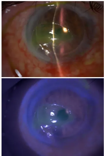 Figure 1 - Limbic cell transplantation. Three months after the procedure, a stable corneal  surface was  maintained