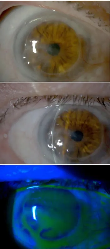 Figure  3  - a  and  b)  Neurotrophic  and  exposure  corneal  ulcer  after  RGTA  treatment