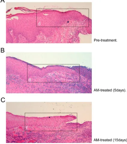 Fig 9. Expression of c-Jun at the epidermal leading edge. Histopathological study of AM induced epithelialisation from a patient´s wound that had been treated with AM
