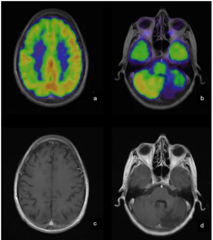 Fig 1. PET and MRI of the brain of patient no 25. Patient no. 25 suffered from a cerebellar hemorrhage and developed a hypometabolic area corresponding to tissue loss in the left cerebellar hemisphere (b + d) in addition to a cerebello-cortical diaschisis 
