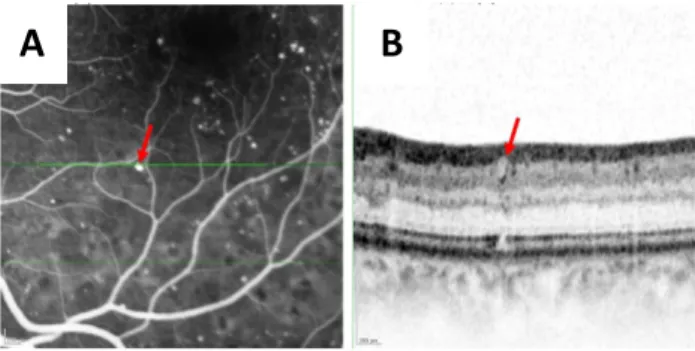 Figure 3 - A microaneurysm with a complete capsular structure. B. Magnified SD- SD-OCT image corresponding to the green line in early phase FA image (A), showing  the microaneurysm (red arrow) with oval shape, complete capsular structure and  heterogenous 