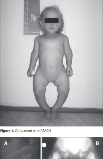 Figure 1. Our patient with PSACH
