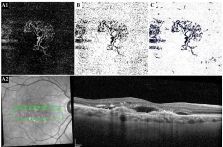 Figura 1 – Imagens de Tomografia de Coerência Óptica – Angiografia (OCT-A) que  demonstram o processo de filtragem de ruído de fundo no caso de uma doente com  uma neovascularização coroideia do tipo 1