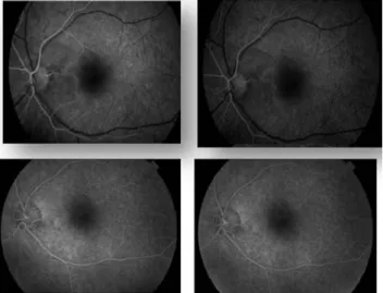 Figure 5 -  MACULAR OCT OF THE LEFT EYE–  2 MONTHS AFTER THE  OCCLUSION: Decreased retinal thickness and flattening of the foveal depression