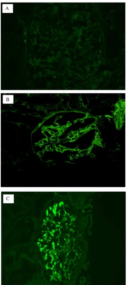 Fig 2. Typical results of immunofluorescence (IF) staining. A shows a negative IF result, B shows a positive result for the linear peripheral pattern and C shows a positive result for the granular mesangial pattern.