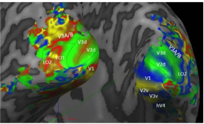 Figura 3 – Exemplo de mapa retinotópico obtido para um doente com LIOmf.  