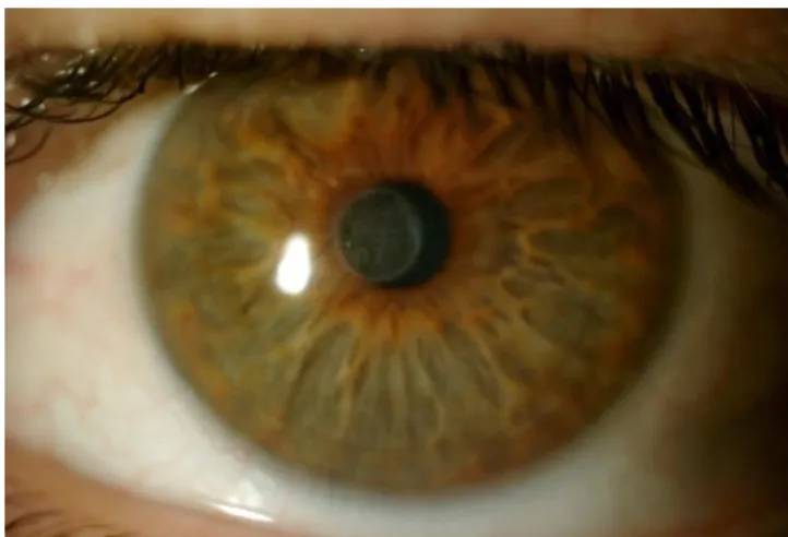 Figure 4 - Corneal haze in the inlay’s former location. 