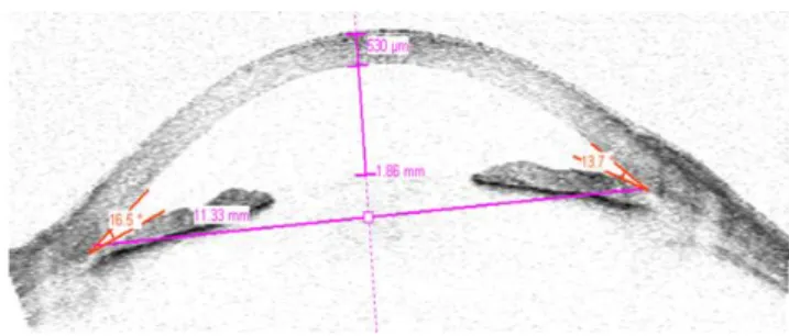 Figura  1  - Imagem  de  alta  resolução  do  segmento  anterior,  com  quantificação  da  PCA e AIC 