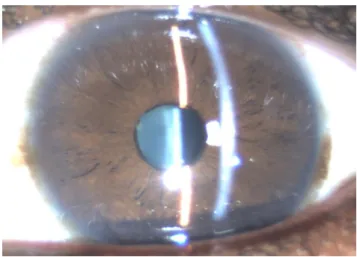 Figura 2 - Retinografia ODE na apresentação – vitrite e edema macular OE. Edema  do disco ótico bilateral