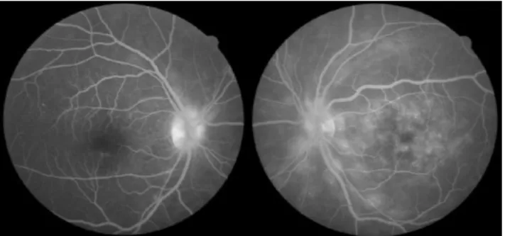 Figura  8  -  Retinografia  ODE  4  meses  após  início  de  corticoterapia  sistémica  –  melhoria do edema do disco ótico bilateral