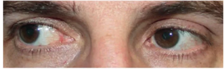 Fig. 9 | Paresia bilateral do VI par, com possibilidade de fixação  em posição primária com o olho parético e aspeto após  miopexia de ambos os retos mediais