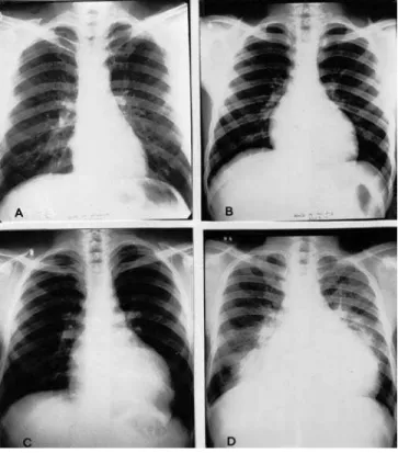 Figure 4. Chest X-Ray of 4 Different Patients with Chagas Heart  Disease
