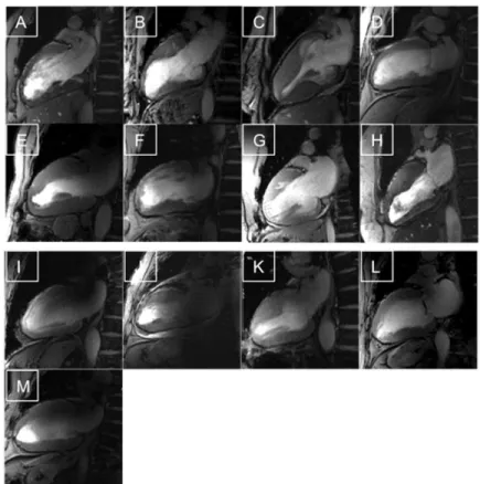 Fig 1. Feasibility of CMR in HCM patients at 7.0T. High Resolution CINE images of each patient (slice thickness 2.5 mm) All images were evaluable as shown by these two-chamber views, but the quality scoring revealed differences