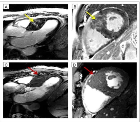 Fig 3. Case example: Patient with myocardial crypts. In the top row fibrosis imaging (LGE at 3.0T) is shown