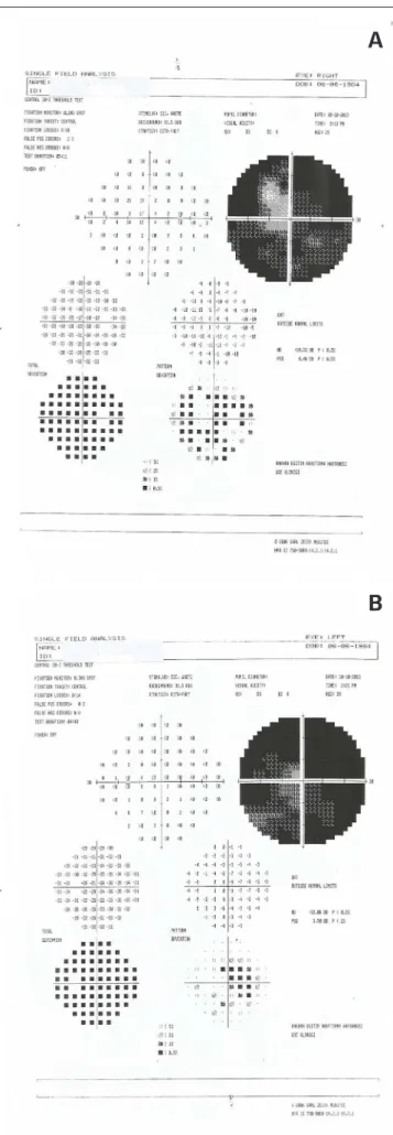 Figure 4. Visual ield analysis of the right eye (A). Visual ield analysis of the let  eye (B).