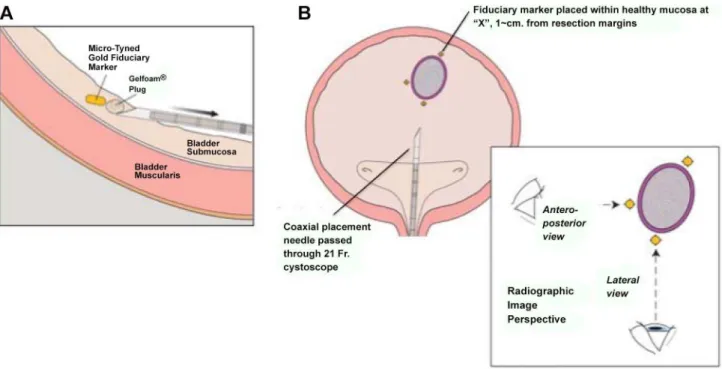 Figure 3. A. During placement, the tip of the deployment needle should be tunneled (approximately parallel to the bladder wall) a short distance beneath the mucosa before the stylet is advanced to deploy the marker and Gelfoam TM plug