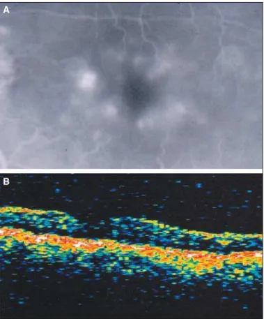 Figure 1 - A: Fluorescein angiogram demonstrating late leakage in a petalloid pattern consistent with cystoid macular edema and B: