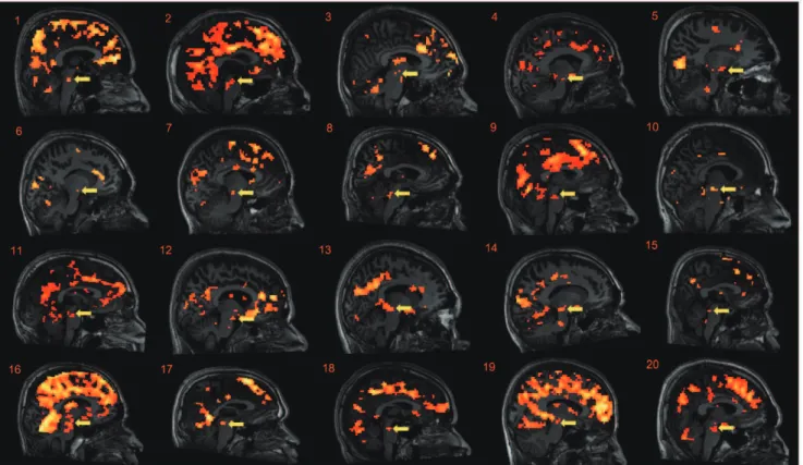 Figure 4. Individual analyses. Deactivation in the midbrain reflecting compensatory effort (i.e., [Pre H – PostH] – [PreE – PostE]) was re-analyzed on an individual basis within the subject’s native space, and each anatomical image was overlain on the mid-
