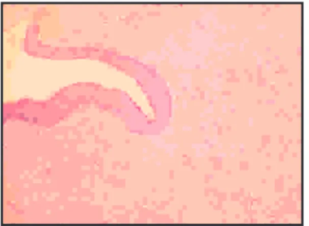 Fig  2:  Photomicrograph  showing  cystic  cavity  lined  by  epithelium and foci of  giant cell granuloma.( H&amp; E, 4X) 