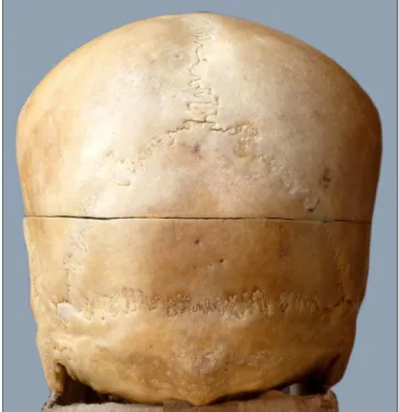 Figure 1. Photograph showing Inca – interparietal bone.