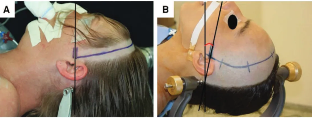 Figure 8. (A) Schematic draw showing the rotation of the head. (B) Drawing which shows the extention of the head.