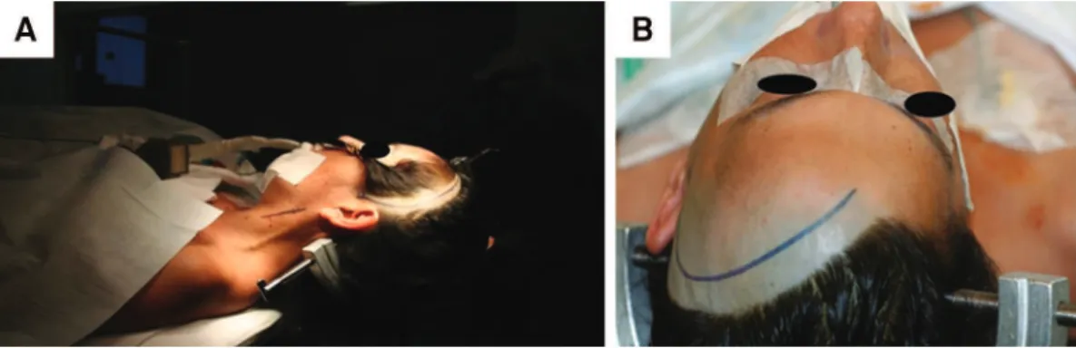 Figure 10. (A) Head positioning for pterional craniotomy in a patient with ICA ophthalmic segment