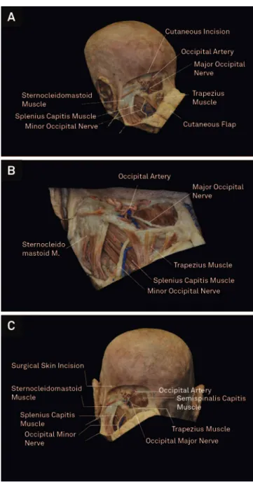 Figure 2. (A) Cadaverous specimen in a posterior view showing the appropriate cutaneous incision mark