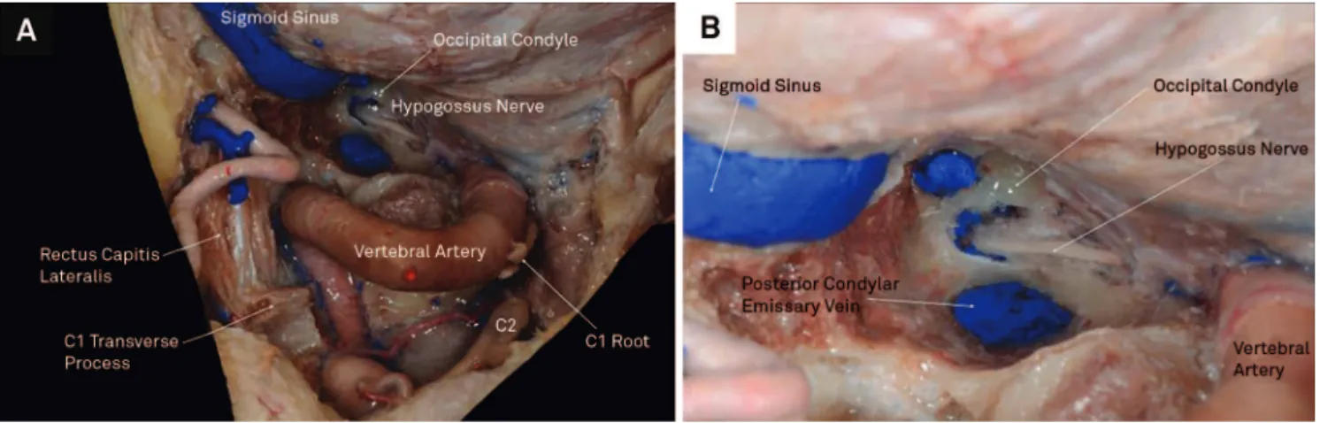 Figure 9. (A) Cadaverous specimen after retro-sigmoid craniotomy in order to perform the far lateral approach