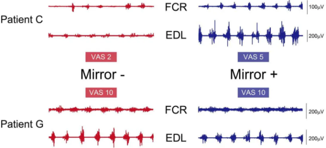Figure 4. Representation of the different two types of EMG changes due to MVF. Patient C (top panel) showed remarkable increase of VAS and EMG amplitude due to MVF while Patient G (bottom panel) did not show obvious changes in both VAS and EMG activities.
