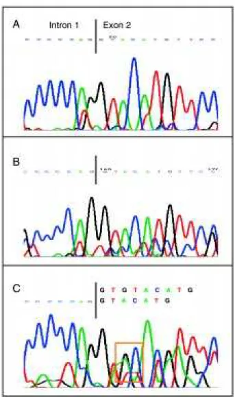 Figure 2 - Genomic DNA sequencing of patients with CGD and contol: analysis of the sequence of the exon 2 of the NCF-1 gene