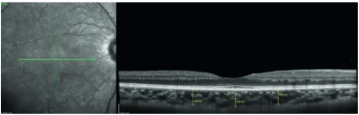 Tabela 6 | Valores de espessura de coroideia a 1 mm nasal à  fóvea antes e após a HD. 