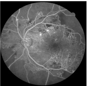 Fig. 4 | Angiografia fluoresceínica em doente com RDP e extensa oclu- oclu-são capilar periférica.