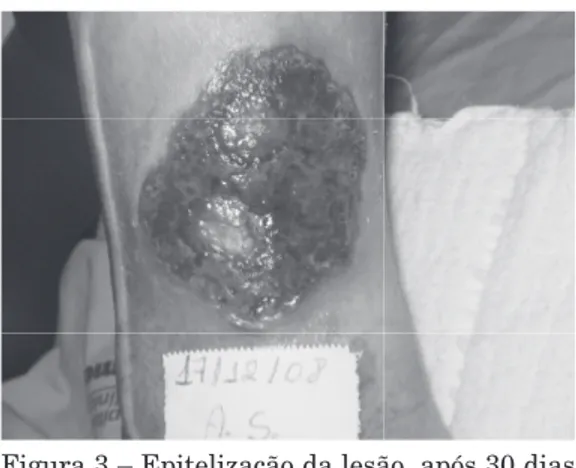 Figura 2 – Úlcera venosa recoberta com tecido  de granulação, redução da  hipere-mia  e  do  edema  (após  18  dias  de  tratamento tópico).