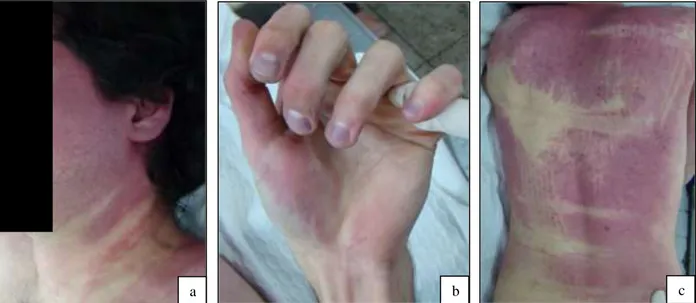 Fig. 1. As três imagens indicam as áreas de hipóstase, intensamente avermelhadas, observadas na região esquerda da face (a), na mão esquerda  (b) e no dorso (c) 
