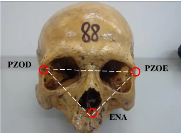 Figura  1.  Peça  anatômica  utilizada  na  pesquisa  evidenciando  os  pontos craniométricos analisados