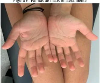 Figura 6: Palmas de mãos bilateralmente 