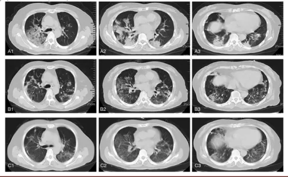 Figure 6: Typical computed tomography (CT) images of the lung. A1 - A3: CT images on day 2 indicate that there  are lesions and an increasing shadow of mass density in the right and left lungs; B1 - B3: CT images on day 20  indicate relief in the right and