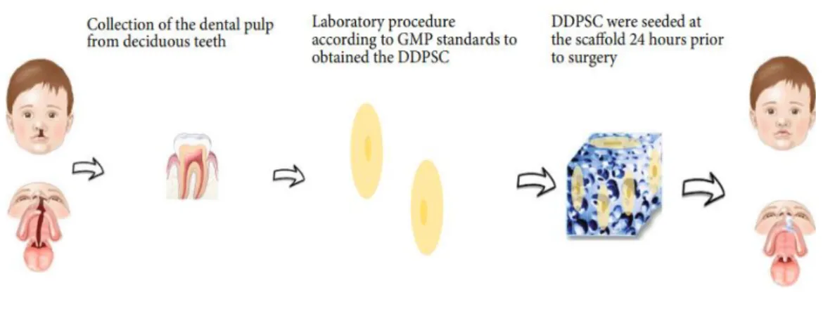 Figure 4: Schematic representation of autologous bone tissue engineering using DDPSC associated with 250 mg  of Bio-Oss Collagen® (TANIKAWA et al., 2020)
